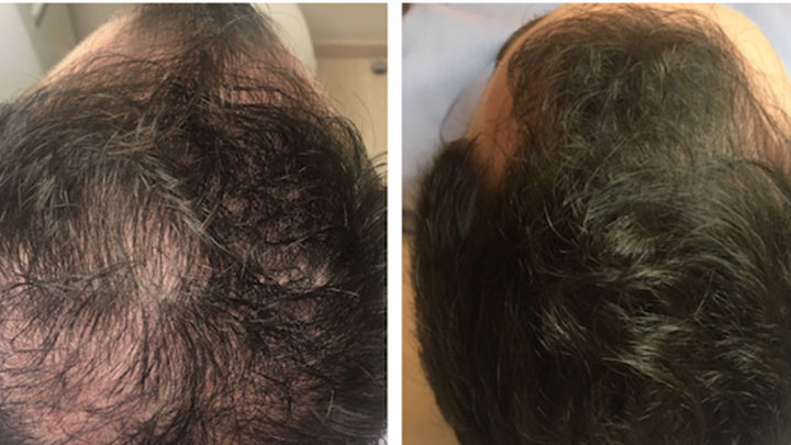Dutasteride en Microneedling para tratar la Alopecia Común