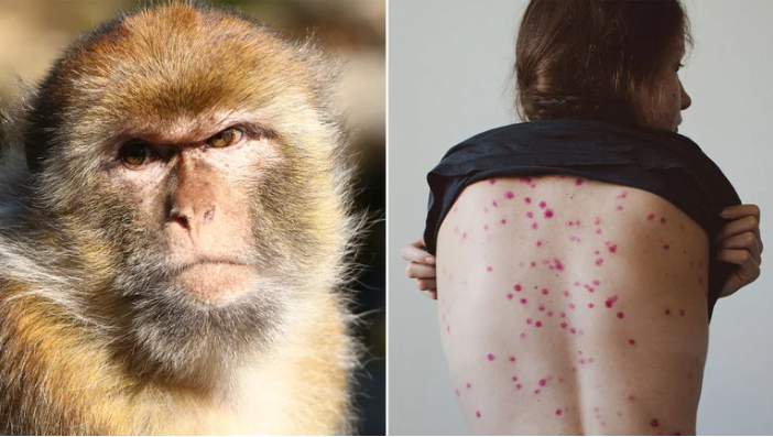 SaludQué dicen los expertos sobre la viruela del mono