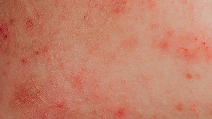 Dermatitis atópica:Cómo es el nuevo tratamiento que reduce la picazón y las lesiones