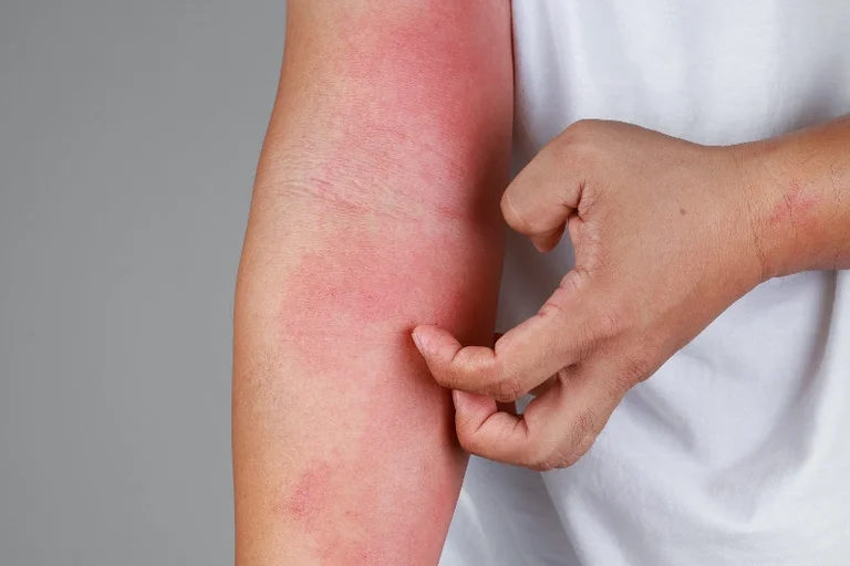Dermatitis Atópica: De qué se trata la enfermedad crónica de la piel que afecta a 1 de cada 10 argentinos