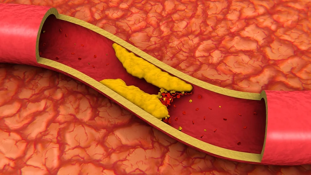 SaludQué es el colesterol genético y cuál es la lipoproteína que debe medirse al menos una vez en la vida