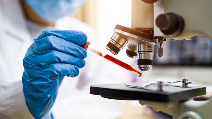 CienciaCómo es el análisis de sangre para tumores difíciles de detectar como los linfomas, los hepáticos y de páncreas