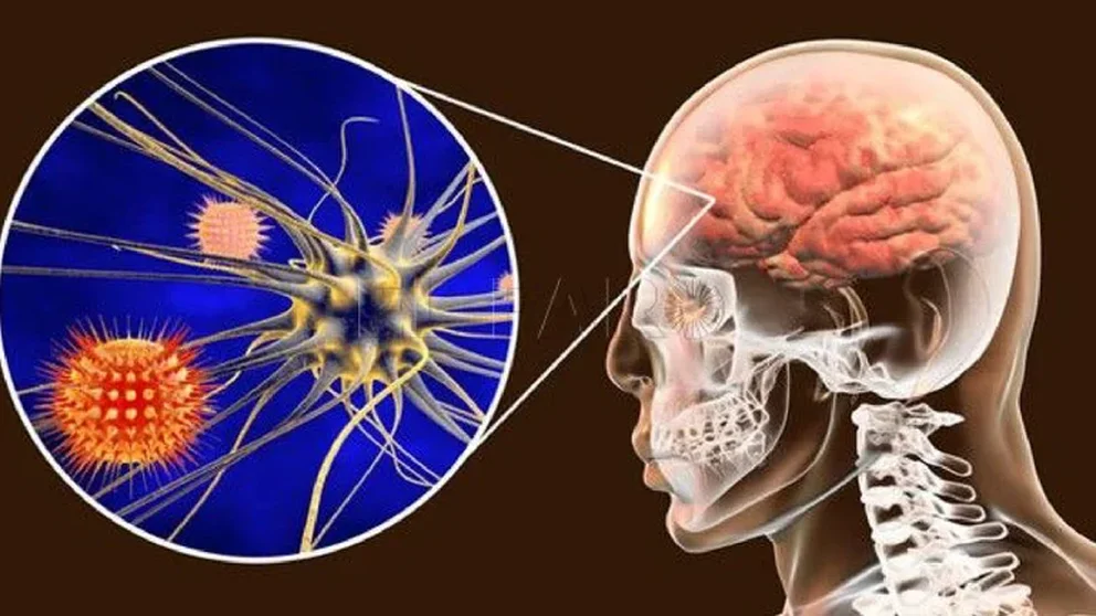 SaludQué es la meningitis, cuáles son sus síntomas y cómo tratarla
