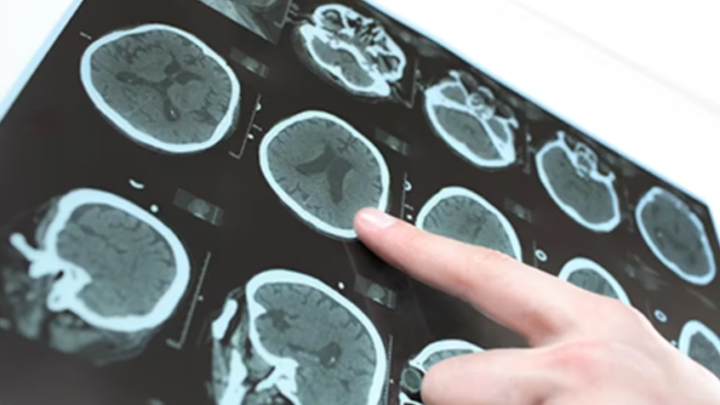 SaludViaje a las células cerebrales: cómo podrían algún día conducir a nuevos tratamientos para el Parkinson